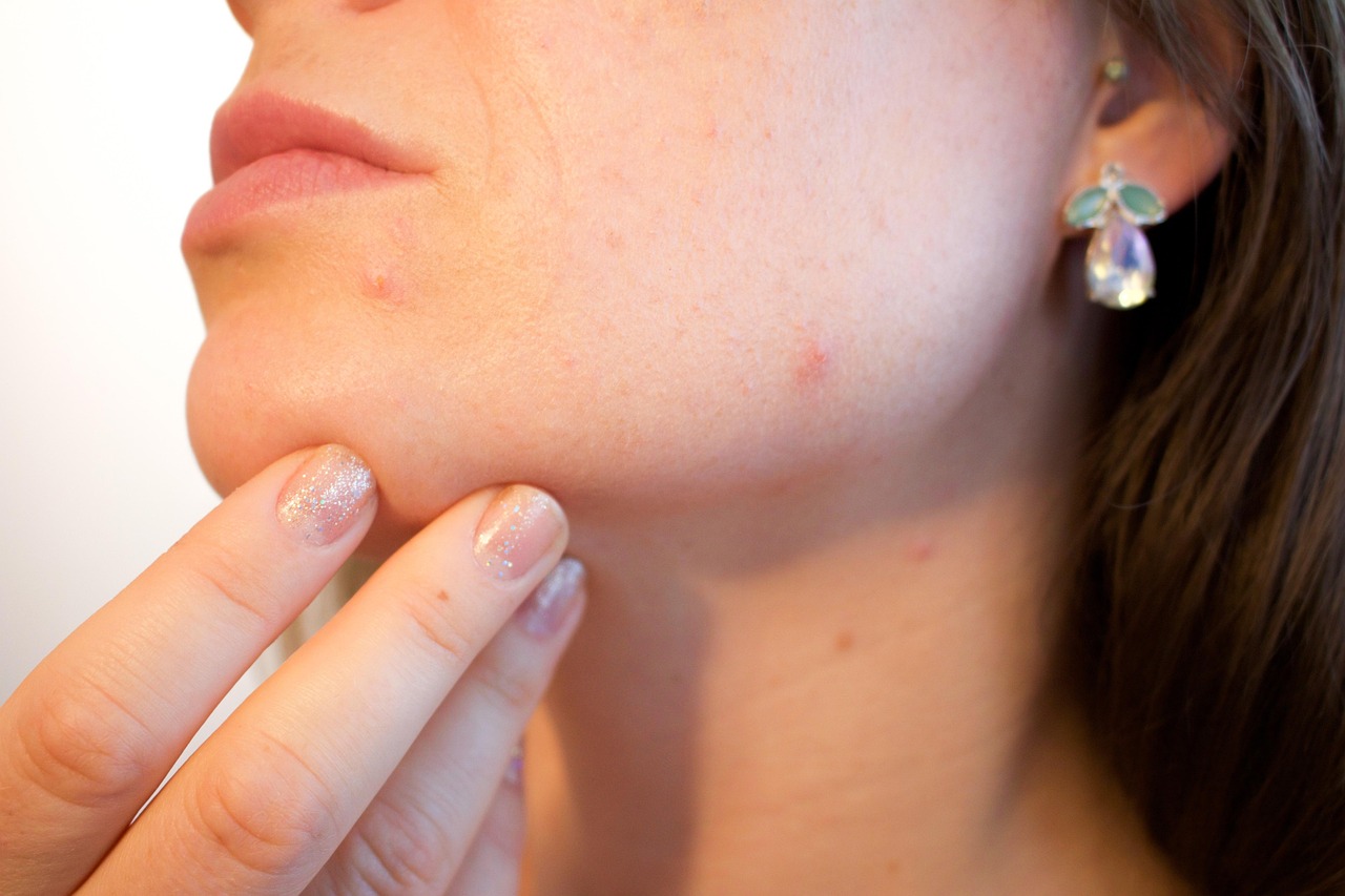 Addio ai brufoletti: come Regene Tea purifica la pelle in modo naturale